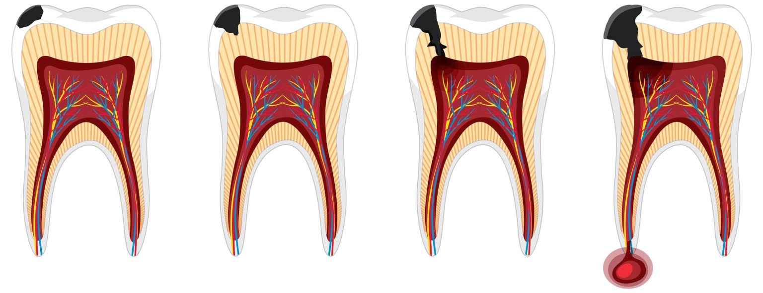 What is Root Canal (Endodontics) Treatment
